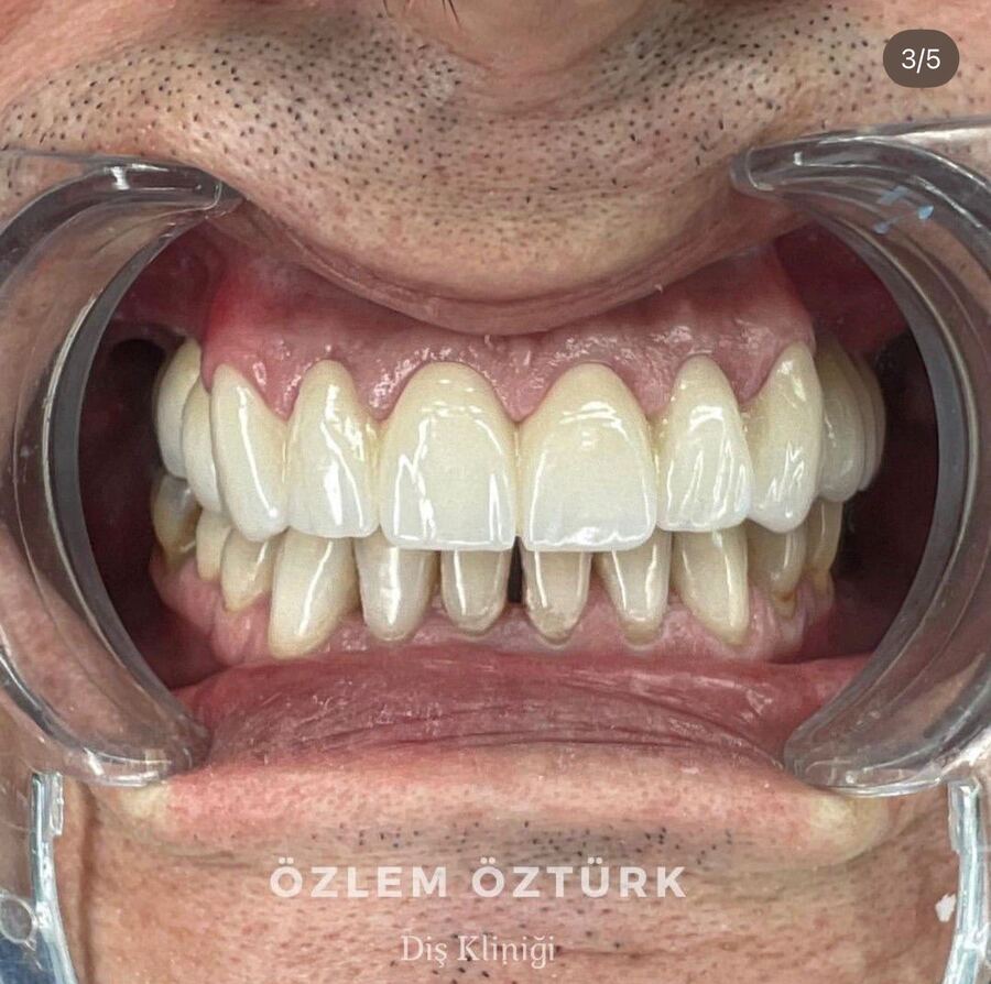 Gülüş tasarımı sonrası