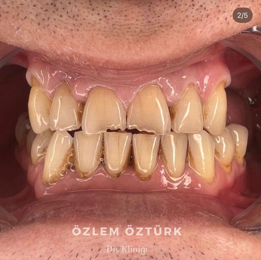 Gülüş tasarımı öncesi