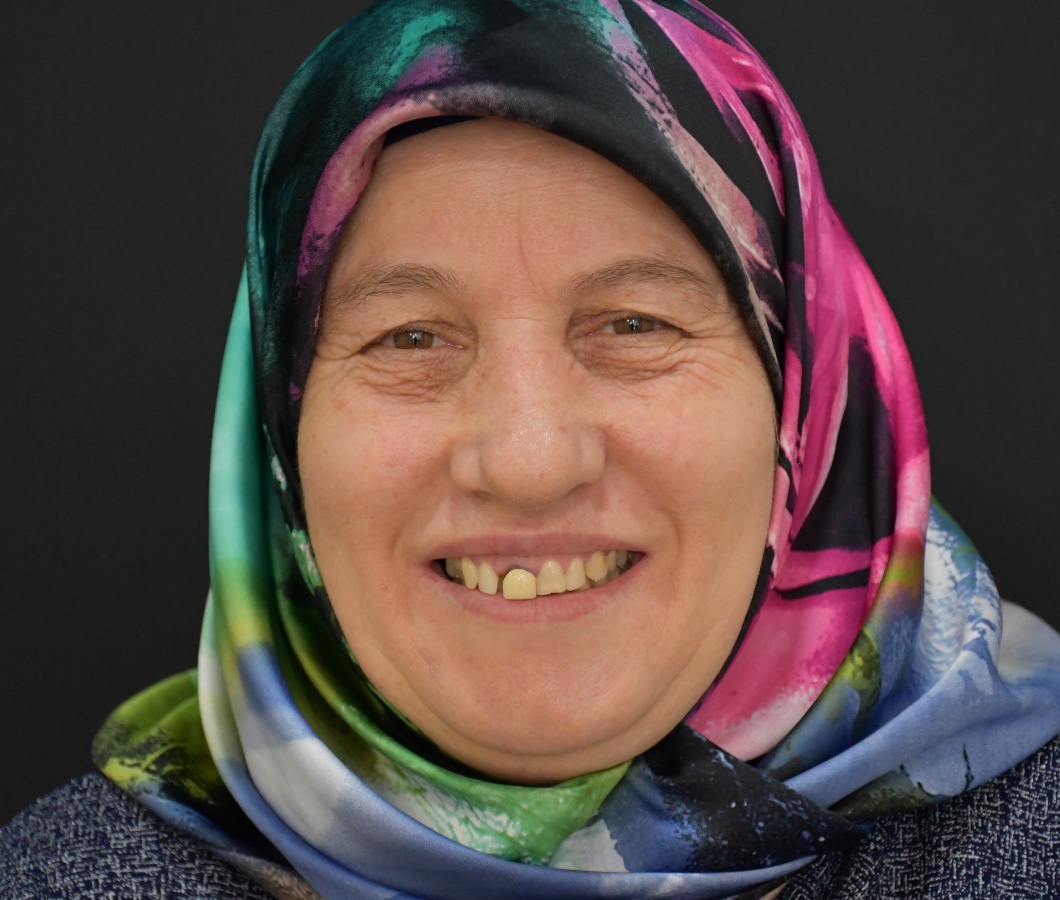 Kapsamlı gülüş tasarımı öncesi hasta gülüşü