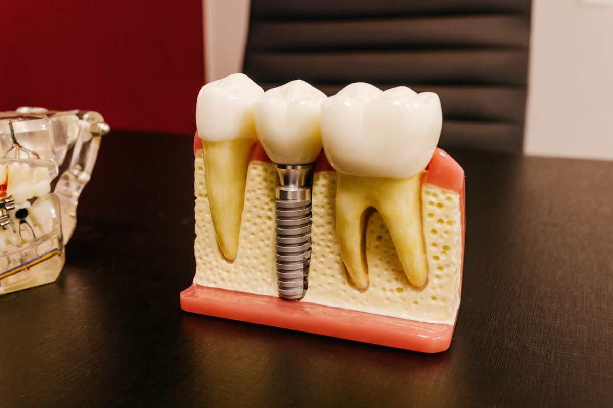 Diş etine yerleştirilmiş bir implant vidasını gösteren kesit model